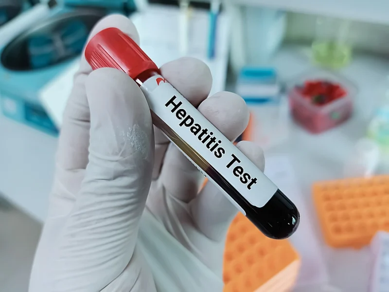 Schéma žloutenky typu A, hepatitida