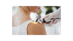 Výsledky prevence melanomu v lékárnách BENU
