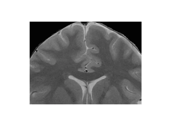 Gliom: Jak ovlivňuje život mladých lidí